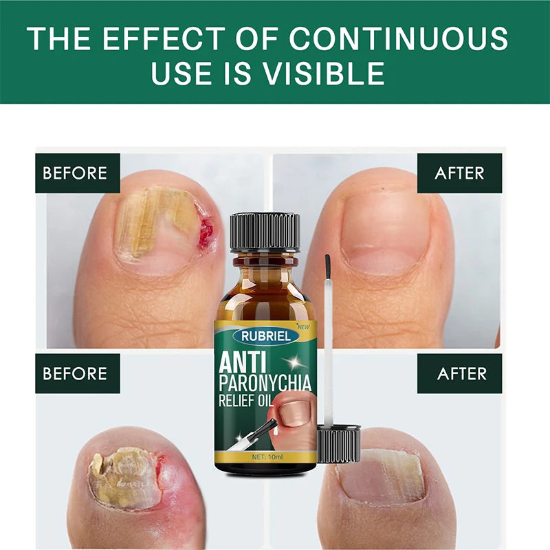 ✨🪔 New Year Dhamaka Sale 🎁💥 Anti Paronychia Relief Oil – Heal Infected Nails & Reduce Swelling Naturally 🌿💧 | BUY 1 GET 1 FREE!