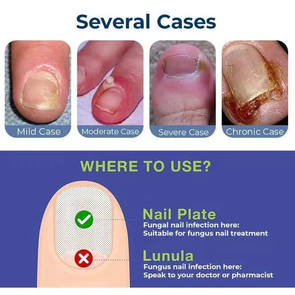 ✨🪔 New Year Dhamaka Sale 🎁💥 Anti Paronychia Relief Oil – Heal Infected Nails & Reduce Swelling Naturally 🌿💧 | BUY 1 GET 1 FREE!