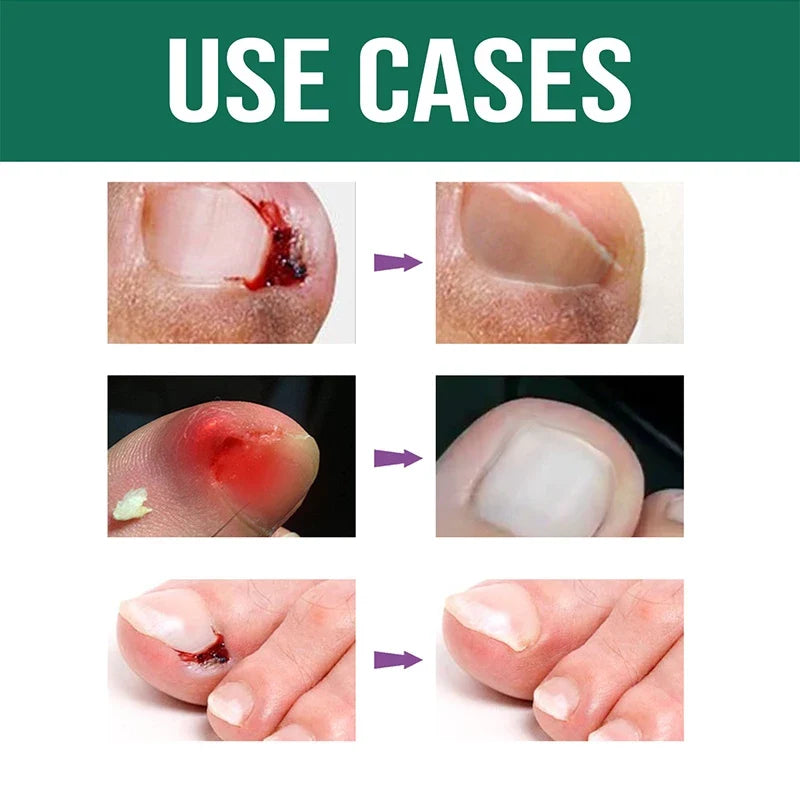 ✨🪔 New Year Dhamaka Sale 🎁💥 Anti Paronychia Relief Oil – Heal Infected Nails & Reduce Swelling Naturally 🌿💧 | BUY 1 GET 1 FREE!