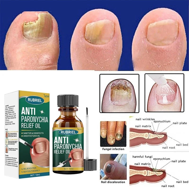 ✨🪔 New Year Dhamaka Sale 🎁💥 Anti Paronychia Relief Oil – Heal Infected Nails & Reduce Swelling Naturally 🌿💧 | BUY 1 GET 1 FREE!